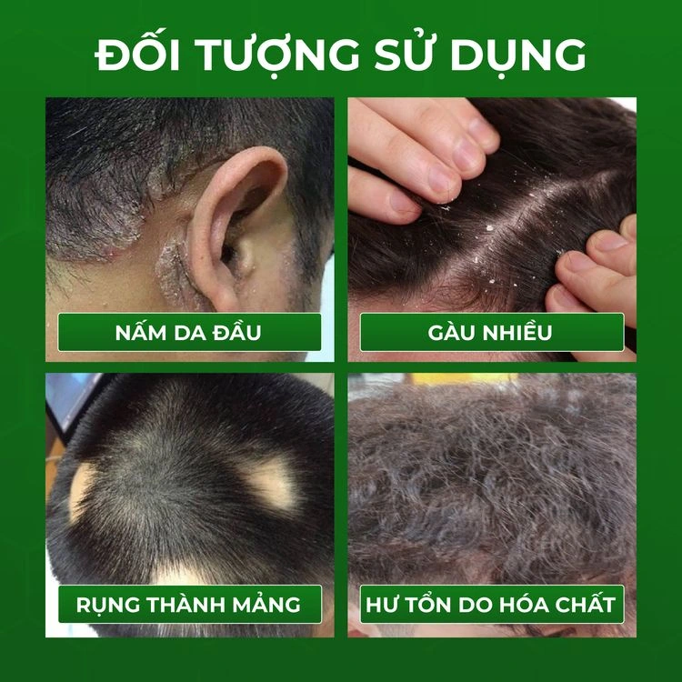 Đối tượng sử dụng theo trang mẫu: nấm da đầu, gàu nhiều, rụng thành mảng, hư tổn do hóa chất